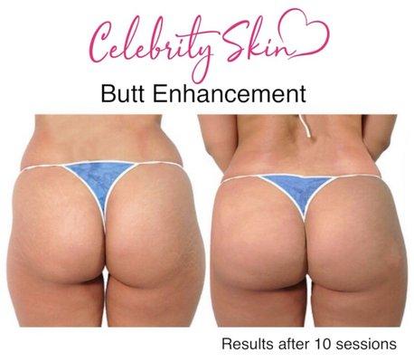 Vacuum Therapy for natural butt enlargement, shaping, and lifting