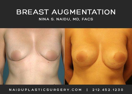 Nina S. Naidu, MD FACS  (212) 452-1230  http://www.naiduplasticsurgery.com   IG: https://www.instagram.com/drnaidu_plasticsurgery/