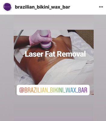 Laser Fat Removal Special $$ Tummy Area $175.00 1hour session! Loose inches INSTANTLY!