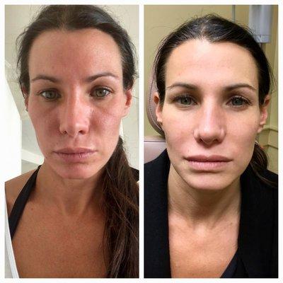 Botox, Dysport, Restylane, Sculptra