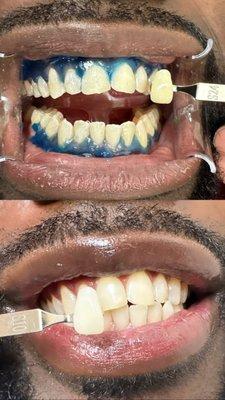 Teeth whitening