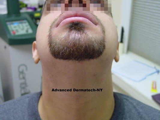 Beard (w/ Throat) Single Treatment