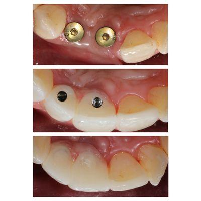 Screw-retained implant crowns on upper front teeth