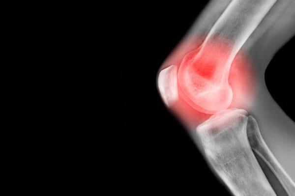 Our Knee Pain program, gives patients with arthritis and knee degeneration relief without the need for prescription medication surgery.