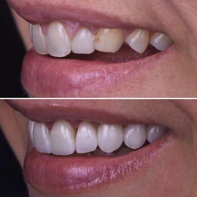 Smile enhancement with porcelain veneers. Case designed and executed by Dr. Tatevik Pilosyan.