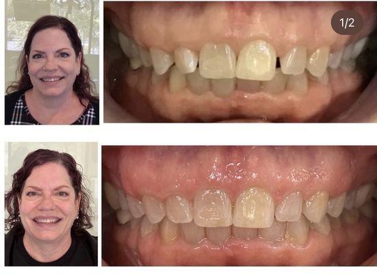 Invisalign before/after