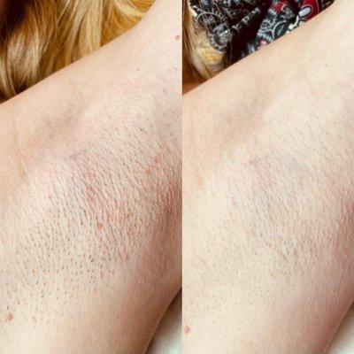 Before + After only ONE underarm laser....Woww!