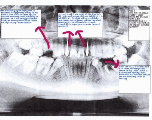 In Jan 2022, Puschak's root canal tooth 19 became missing, Please see the label explanation