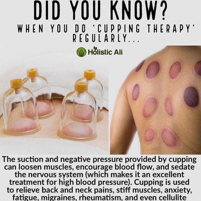 Cupping therapy helps heal!
 #cuppingtherapy #holistichealth