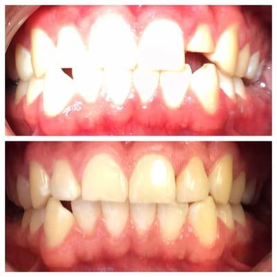 Tooth color filling