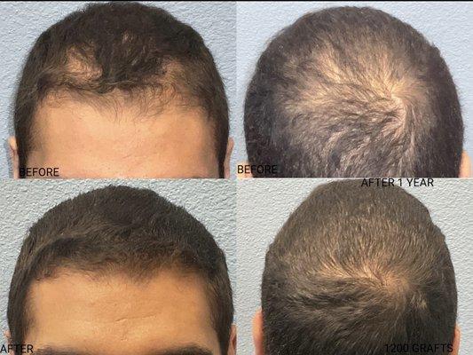 Before / After (1200 grafts)