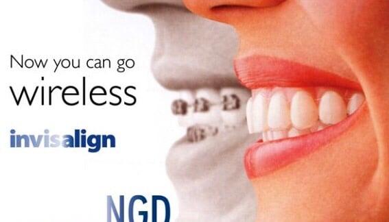 Non Metal Alternative  Treatment to Dental Braces