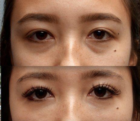 Before and After Lower Eyelid Tear Trough Filler - No Surgery