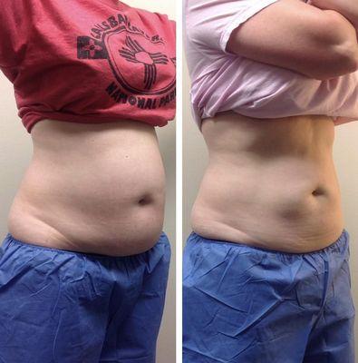 CoolSculpting before and after