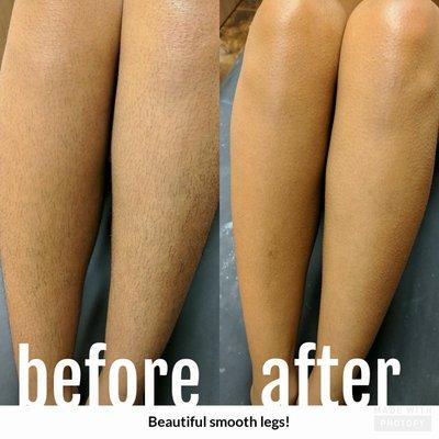 Full leg before and after