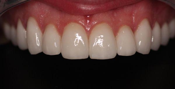 Porcelain Veneers