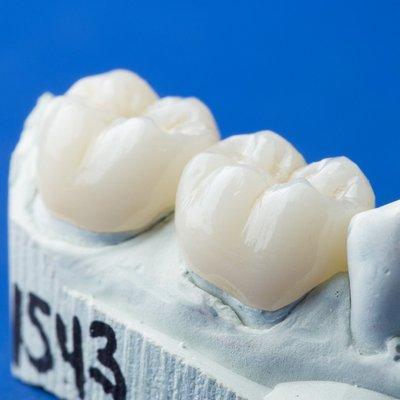 Full zirconia crowns.