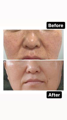 Skintox and facial treatment