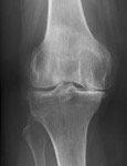 knee arthritis