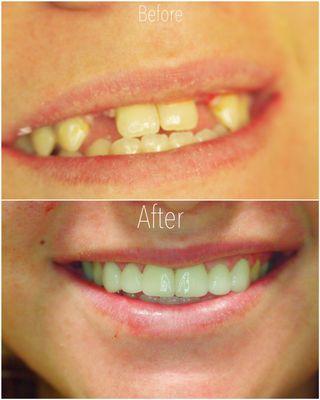 Patient congenitally missing teeth #7 & #10, Dr.Tanioka did bridge work to restore her smile!