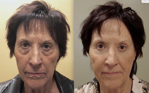 Before and After Eyelid Surgery