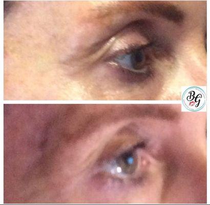 Skin tightening on upper and lower eye lids