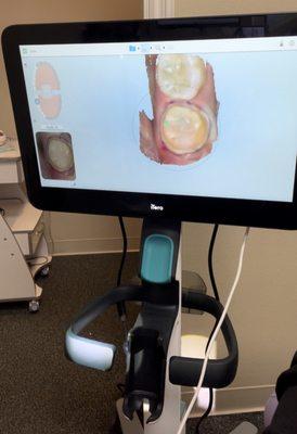 Digital scan of my tooth! No more yucky impressions!