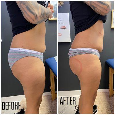 1st session booty lift and 45 mins laser lipo