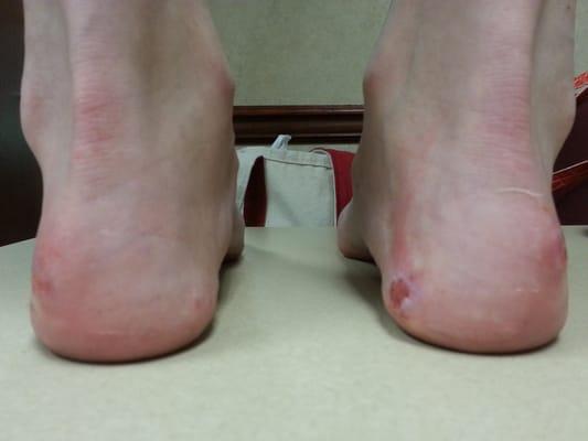 Damage from bad pedicure.