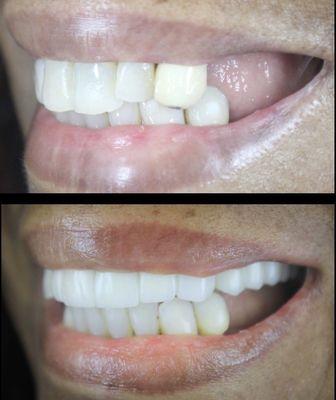 #cosmetic #zirconia # implants