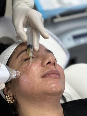 PRP facial