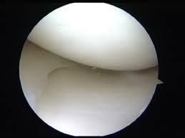 Arthroscopy is the tool of sports medicine- view of a healthy knee and meniscus