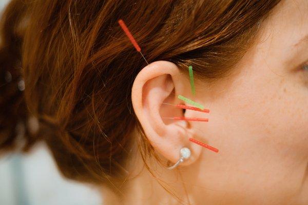 Ear acupuncture