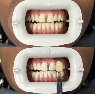 Before and after teeth whitening results.