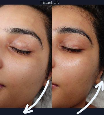 Rejuvenation Facial Before and After!