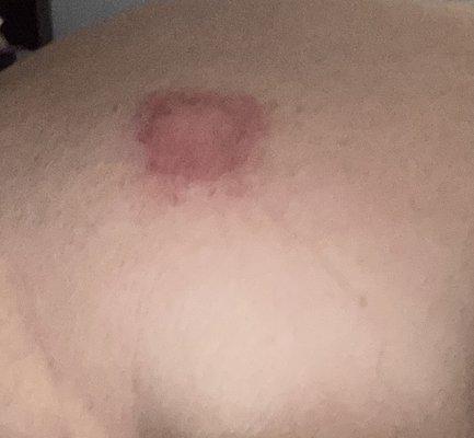 Burn on my upper back from hot stone used in chair massage