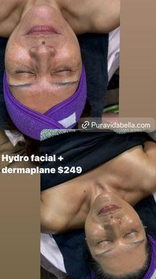 Hydrofacial+dermaplane+peel