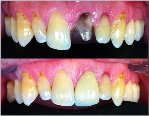 Single tooth replacement on previous root canal tooth that has naturally turned dark.  Highly esthetic case that came out fantastic.w