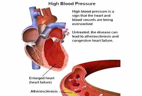 High Blood Pressure