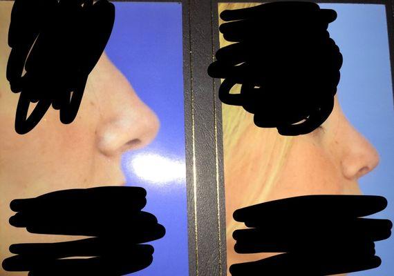 Photo on left is POST botched Jamie Derosa rhinoplasty. Photo on right is post my revision rhinoplasty with other surgeon