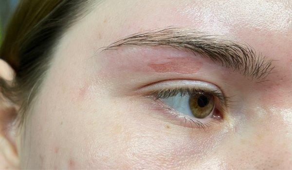 Ripped skin after eyebrow waxing