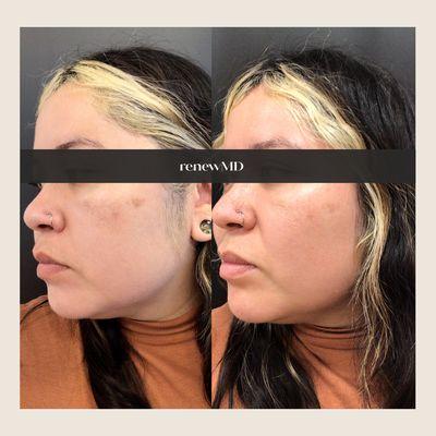 Dark Spots, Hyperpigementation fading using Picosure Pro laser. RenewMD is nationally recognized for laser resurfacing for darker skin tone