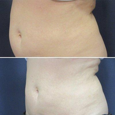 SculpSure Treatment- Before and After one treatment!