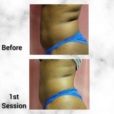 Non-Invasive Body Sculpting