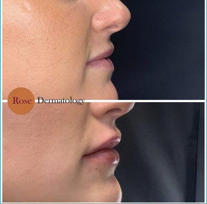 Before and after filler