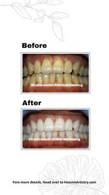 Before and after laser teeth whitening