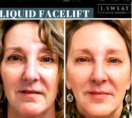 A liquid Facelift completed by Dr. Jeffrey Sweat