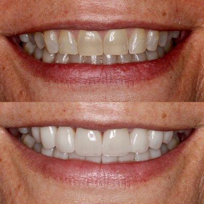 Smile makeover with natural looking beautiful porcelain veneers!!