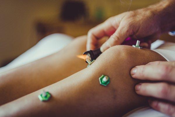 Moxibustion