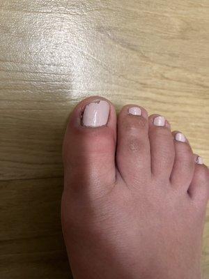 infected toe